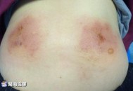 做艾灸致2度烫伤,艾灸烫伤后疼痛和发白是感染吗？