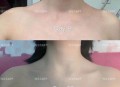女子打瘦肩针险丧命,瘦肩针200和300区别？