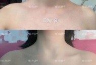 女子打瘦肩针险丧命,瘦肩针200和300区别？