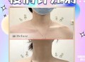 女子打瘦肩针险丧命,瘦肩针大概多少钱？