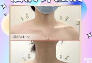 女子打瘦肩针险丧命,瘦肩针大概多少钱？