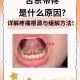 舌根和牙龈被缝一起,牙龈肿痛，口干舌燥的，舌根疼痛，不知道是什么原因导致的？