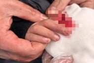 女童指尖被夹断,一根手指夹断了一小节算几级伤残？