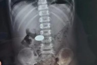 男童误吞遥控器电池,遥控器吃电是怎么回事？