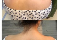 女子打瘦肩针险丧命,有打过瘦肩针的美女吗