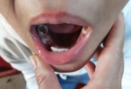 女童脑子被啃20个洞,吃小孩大脑的动物？