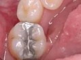 网购5元材料自行补牙,淘宝补牙的材料靠谱吗？