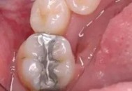 网购5元材料自行补牙,淘宝补牙的材料靠谱吗？