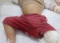 男童被沸水烫伤下肢,男童被沸水烫伤下肢怎么办