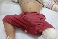 男童被沸水烫伤下肢,男童被沸水烫伤下肢怎么办