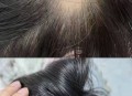 掉发超6根可能是脱发,洗头时掉头发近50根正常吗？