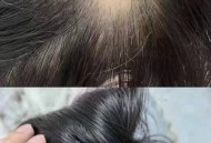 掉发超6根可能是脱发,洗头时掉头发近50根正常吗？