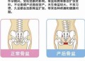 女性盆骨正在缩小,顺产生完怎么缩小骨盆？
