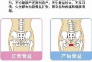 女性盆骨正在缩小,顺产生完怎么缩小骨盆？