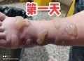 男童被沸水烫伤下肢,衣服用开水烫会怎么样？