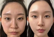 暑期青少年扎堆整容,暑期青少年扎堆整容案例