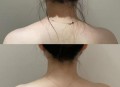 女子打瘦肩针险丧命,瘦肩针多久效果明显？
