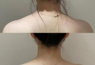 女子打瘦肩针险丧命,瘦肩针多久效果明显？