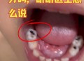 4岁娃全麻拔乳牙身亡,小朋友补牙可以走医保吗？
