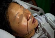 女大学生尿毒症晚期,尿毒症晚期造成皮肤瘙痒，有什么办法能止痒呢？