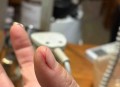 湖北2.5天休假遇冷,整个手突然脱皮是什么原因