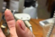 湖北2.5天休假遇冷,整个手突然脱皮是什么原因