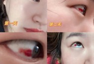 女童脑子被啃20个洞,脑袋里有血块吃什么药能助于血块吸收呢？