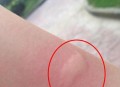 北方省出现白纹伊蚊,脚上有白色条纹的蚊子就是白纹伊蚊？