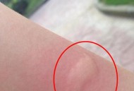 北方省出现白纹伊蚊,脚上有白色条纹的蚊子就是白纹伊蚊？