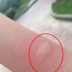 北方省出现白纹伊蚊,脚上有白色条纹的蚊子就是白纹伊蚊？