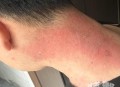 做艾灸致2度烫伤,艾灸严重烫伤