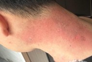 做艾灸致2度烫伤,艾灸严重烫伤