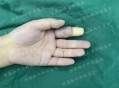 被断4根手指已恢复,被断4根手指已恢复怎么办