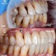 牙周炎一次拔14颗牙,牙周炎一次拔14颗牙可以吗