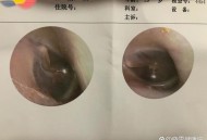 被邻居扇脸鼓膜穿孔,老师把学生打成鼓膜穿孔就怎么办？