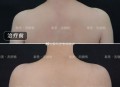女子打瘦肩针险丧命,瘦肩薄背针可以保多久？