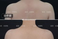 女子打瘦肩针险丧命,瘦肩薄背针可以保多久？