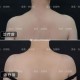 女子打瘦肩针险丧命,瘦肩薄背针可以保多久？