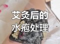 做艾灸致2度烫伤,艾灸不小心把足三里烫伤了，目前长了一圈红疙瘩，继续还是停止？
