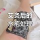 做艾灸致2度烫伤,艾灸不小心把足三里烫伤了，目前长了一圈红疙瘩，继续还是停止？