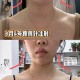 女子打瘦肩针险丧命,瘦肩针效果维持多久？