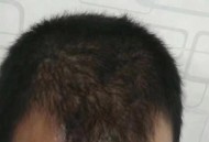 因发量太多剃掉头发,为什么头发剃短了发量少？