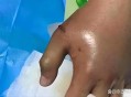被蛇咬反抓蛇再遭咬,被蛇咬反抓蛇再遭咬伤
