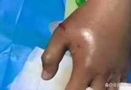 被蛇咬反抓蛇再遭咬,被蛇咬反抓蛇再遭咬伤