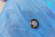 2岁娃误吞纽扣电池,两岁宝宝误吞纽扣电池