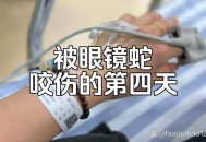 救助眼镜蛇反被咬伤,人被眼镜蛇咬伤会出现哪些症状？