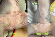 美公园枪击7人受伤,长沙7岁女童公园游玩时被蚊虫“盯上”，长了满腿的丘疹性荨麻疹, 你怎么看？