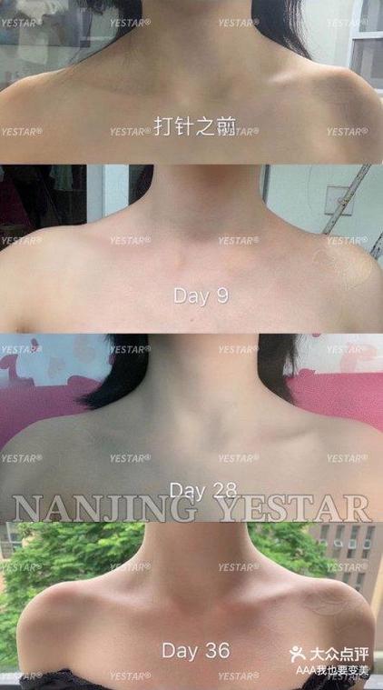 女子打瘦肩针险丧命,瘦肩针200和300区别?