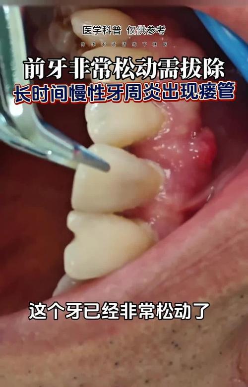 牙周炎一次拔14颗牙,牙周炎,牙齿松疼可以拔吗?