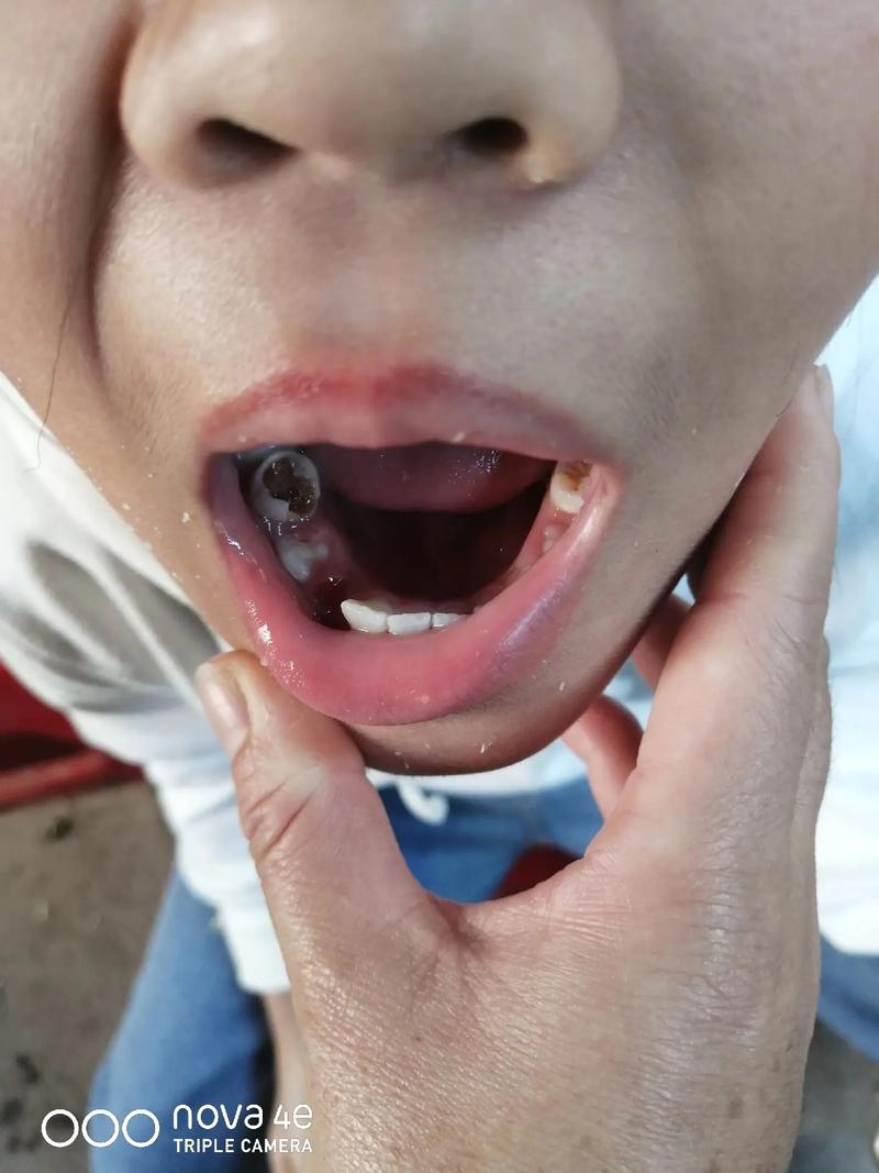 女童脑子被啃20个洞,吃小孩大脑的动物?